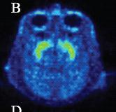 + Cocaine Rhesus macaque PET imaging of the dopamine transporter with