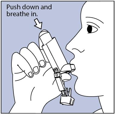Look inside the mouthpiece for foreign objects, and take out any you see. Step 2. Hold the inhaler with the mouthpiece down. See Figure E Figure E. Step 3.