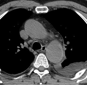 Penetrating Atherosclerotic Ulcer CT Features Extensive atherosclerotic