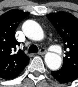 pseudoaneurysm Outline Aortic Rupture Causes Normal anatomy of aortic wall
