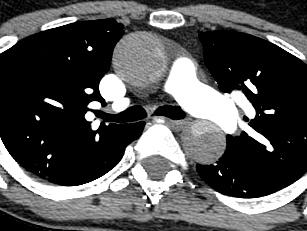 Dynamic Branch Compromise Aortic Dissection Approach to CT
