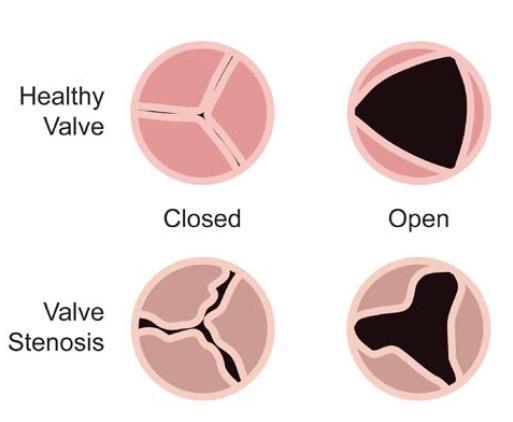 Our TAVI Patients Aortic stenosis is the most frequent acquired valvular heart disease in the industrialized world Incidence increases with age Once symptoms appear, untreated AS is usually fatal