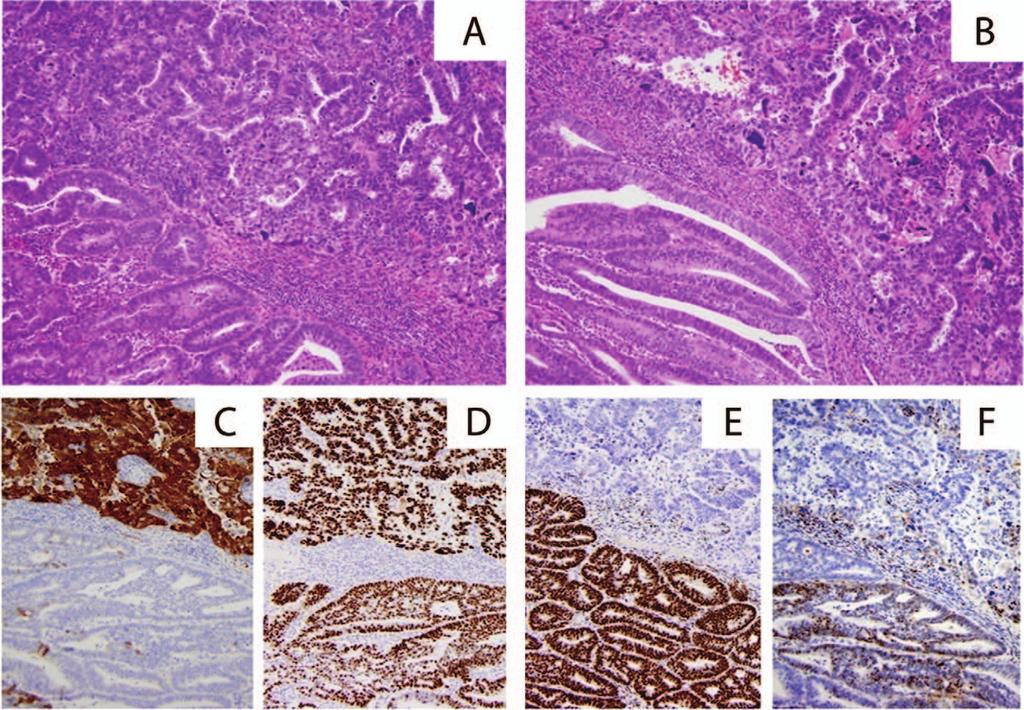 Figure 4. This endometrial biopsy was from a 68-year-old woman. A and B, Tumor shows adenocarcinoma with glandular (lower left) and papillary (upper right) growth patterns.