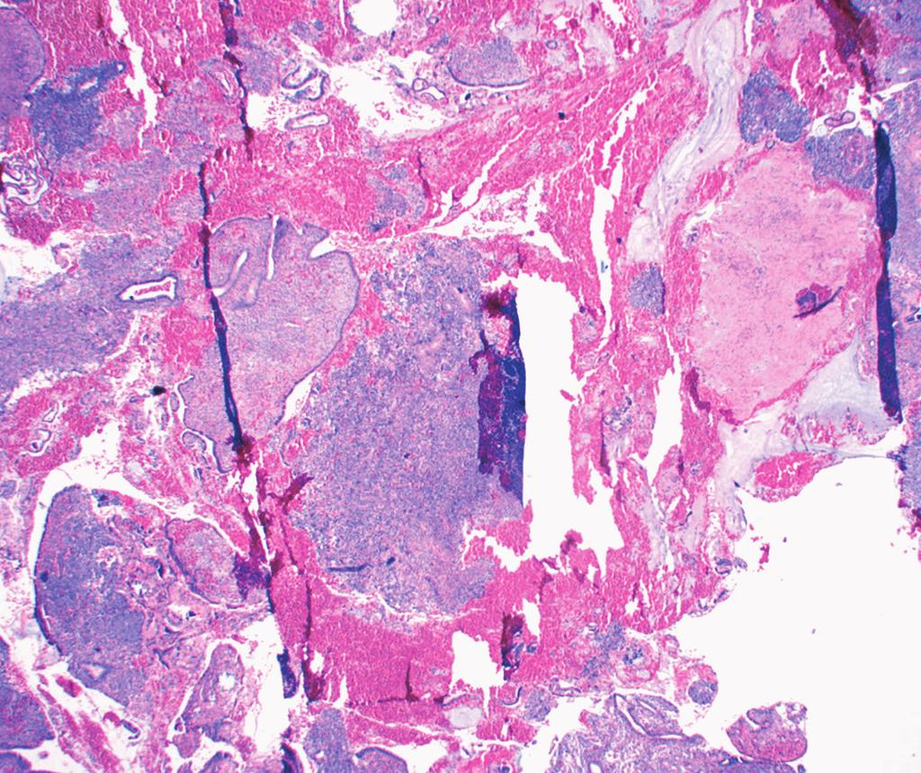 Stemme et al / Biopsy of Endometrial Stromal Tumors B C D Image 1 Histology of aglandular stromal fragments identified in biopsy specimens from patients who were subsequently diagnosed with an