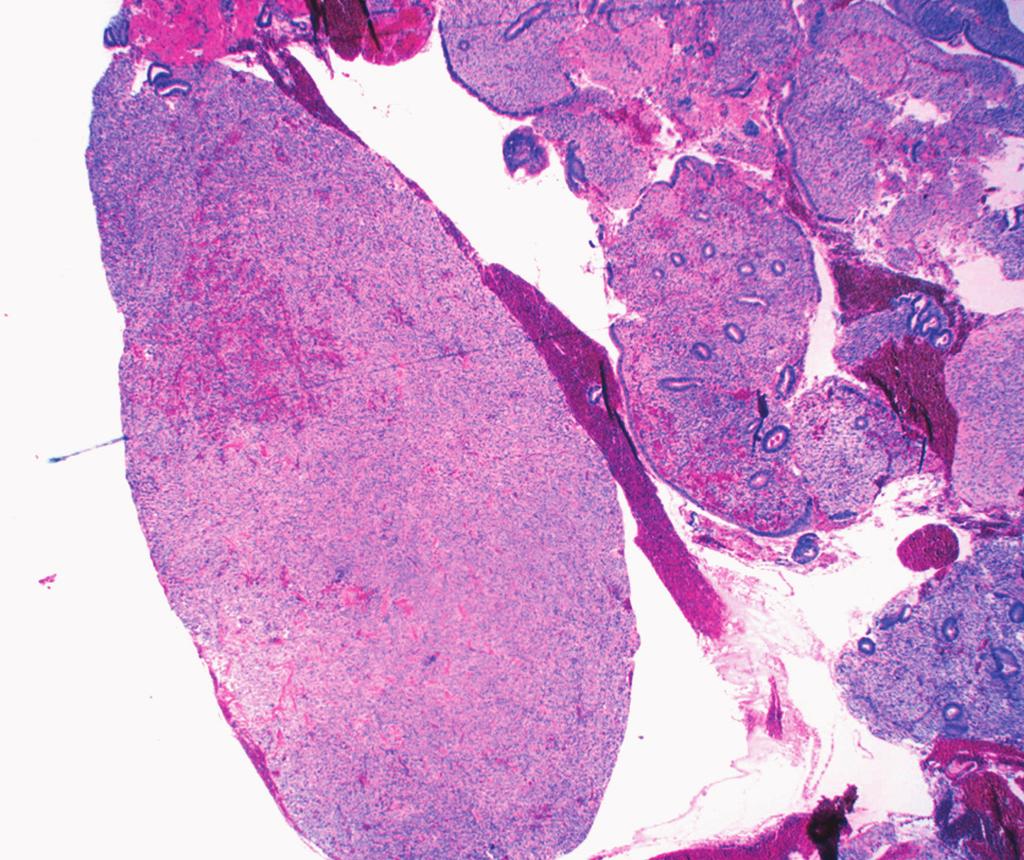 B, Aglandular stromal fragment seen in the first biopsy material from patient 13. The photographed fragment has a size of 4 mm, which is too small to be specific for an EST.