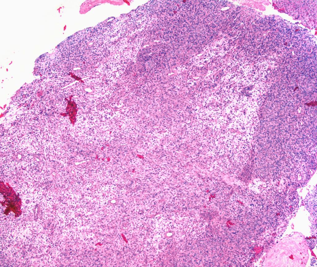 C, Large aglandular fragment, seen in the final biopsy specimen from patient 16, with a size of 5 mm. D, Large aglandular fragment, seen in patient 10, with a size of 17 mm.