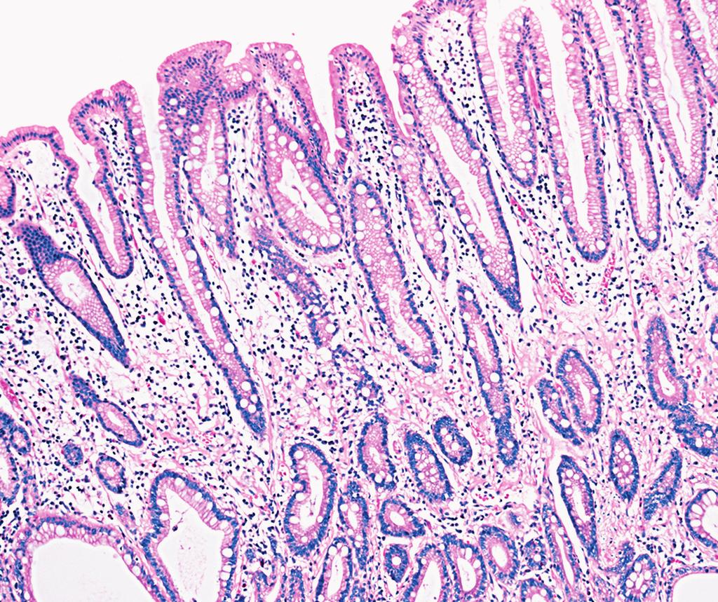 Anatomic Pathology / Original Article A B zimage 1z A, The glands of intestinal metaplasia were isolated by laser capture microdissection (H&E, 100).