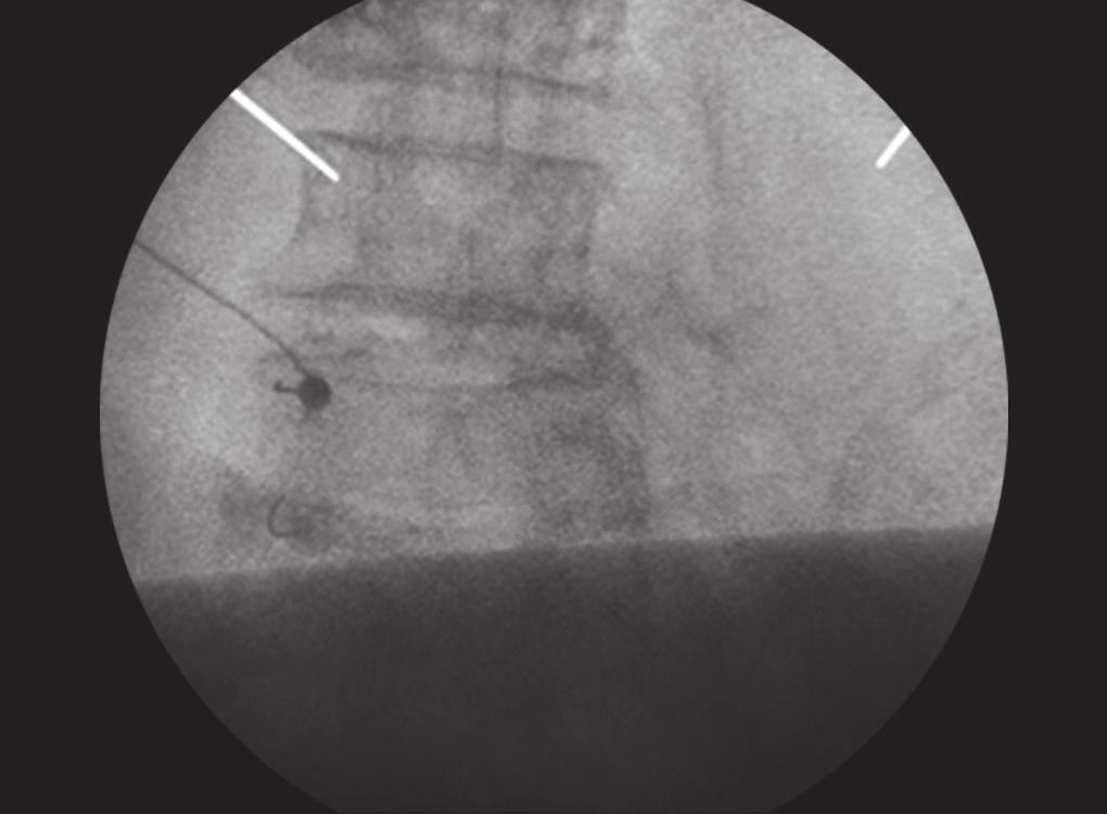 To perform the medial branch block, the patient is positioned in the prone position with a pillow under the abdomen. Fluoroscopic imaging is obtained.