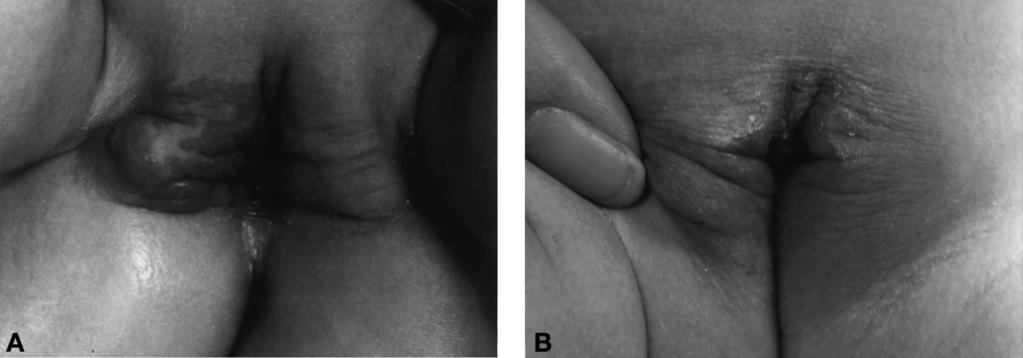 Chang et al: Treatment of Hemangiomas With Laser and Cryogen Fig 2. A 4-month-old Asian girl with obstructive hemangioma of her genital area. (A) View before laser treatment.