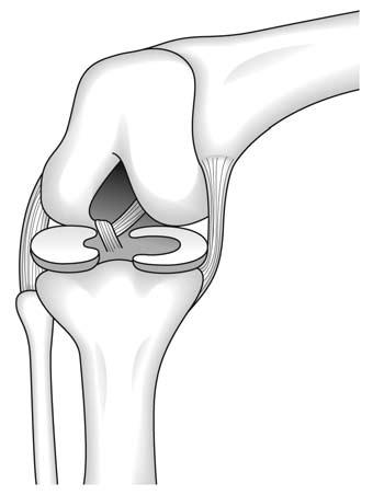 Symptoms of Meniscus Tears Clicking or popping Decreased knee range of motion Instability Joint line tenderness Figure 5. Symptoms of meniscus tears.