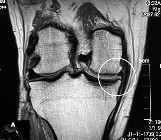 T r e a t m e n t s The traditional management of a torn meniscus most often involves some measure of surgical treatment, such as partial or total meniscectomy, meniscal repair, or meniscal