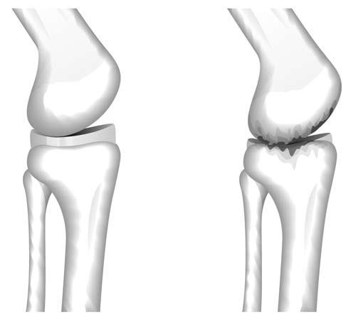 Thus arthroscopic meniscectomy dramatically increases the incidence of future degenerative knee arthritis. Source: 1. Baratz ME, et al.