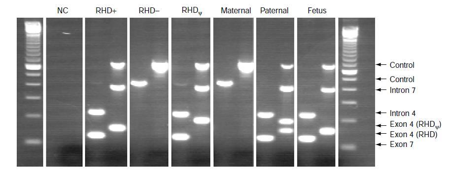 RHD zygosity analysis of the paternal sample - father was heterozygous the chance that offspring from this father will be RHD-positive is 50% the fetus tested