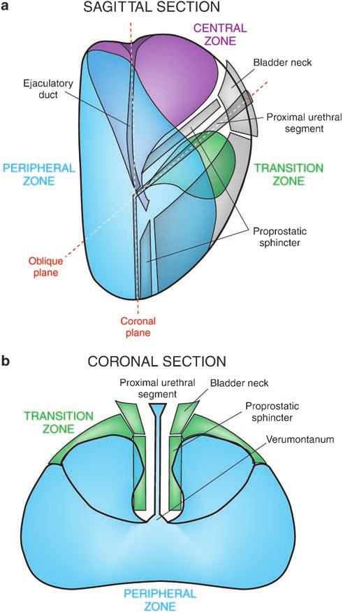 S14 Figure 5 Panel shows glandular tissue to the left and stromal tissue to the right. leads to an increase in urethral resistance.