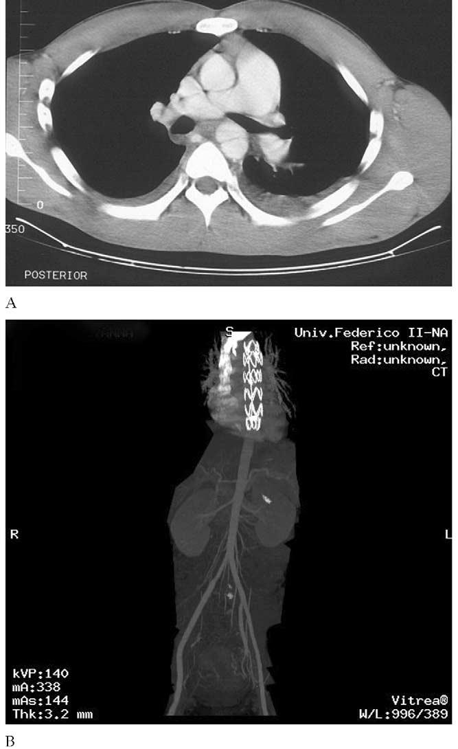 (B) Three months follow-up angiographic computed tomographic scan showing no endoleak and complete thrombosis of the false lumen.