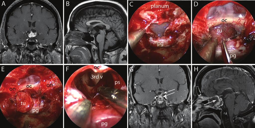 M. Koutourousiou et al. Fig. 5. Images of a suprasellar craniopharyngioma with intraventricular extension treated with GTR via EES.