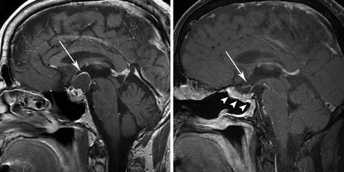 Endoscopic endonasal surgery for craniopharyngiomas TABLE 2: Craniopharyngioma characteristics based on preoperative imaging findings* Fig. 1.