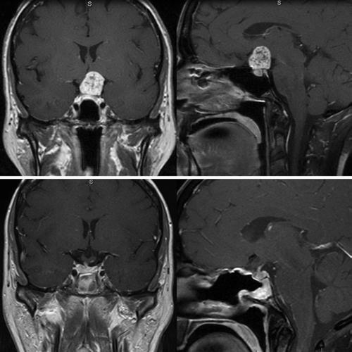 Endoscopic endonasal surgery for craniopharyngiomas in 8 (100%), and GH secretion in 3 (37.5%). Preexisting DI was never resolved; transient DI occurred in 1 patient (7.