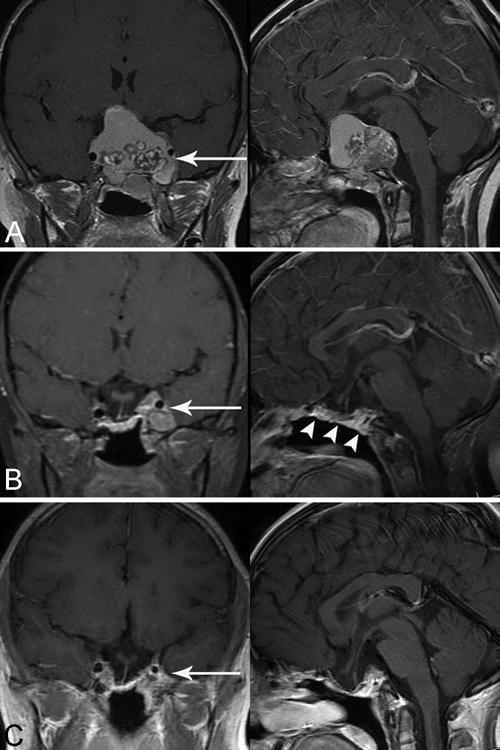 M. Koutourousiou et al. Fig. 3. Coronal and sagittal postcontrast T1-weighted MR images obtained in a pediatric patient with invasive craniopharyngioma.