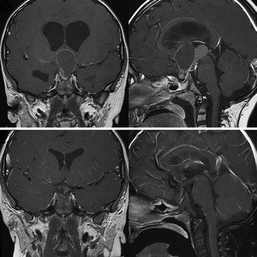 extends into the prepontine cistern deforming the brainstem. B: Postoperative images demonstrating extensive, safe resection of the tumor.