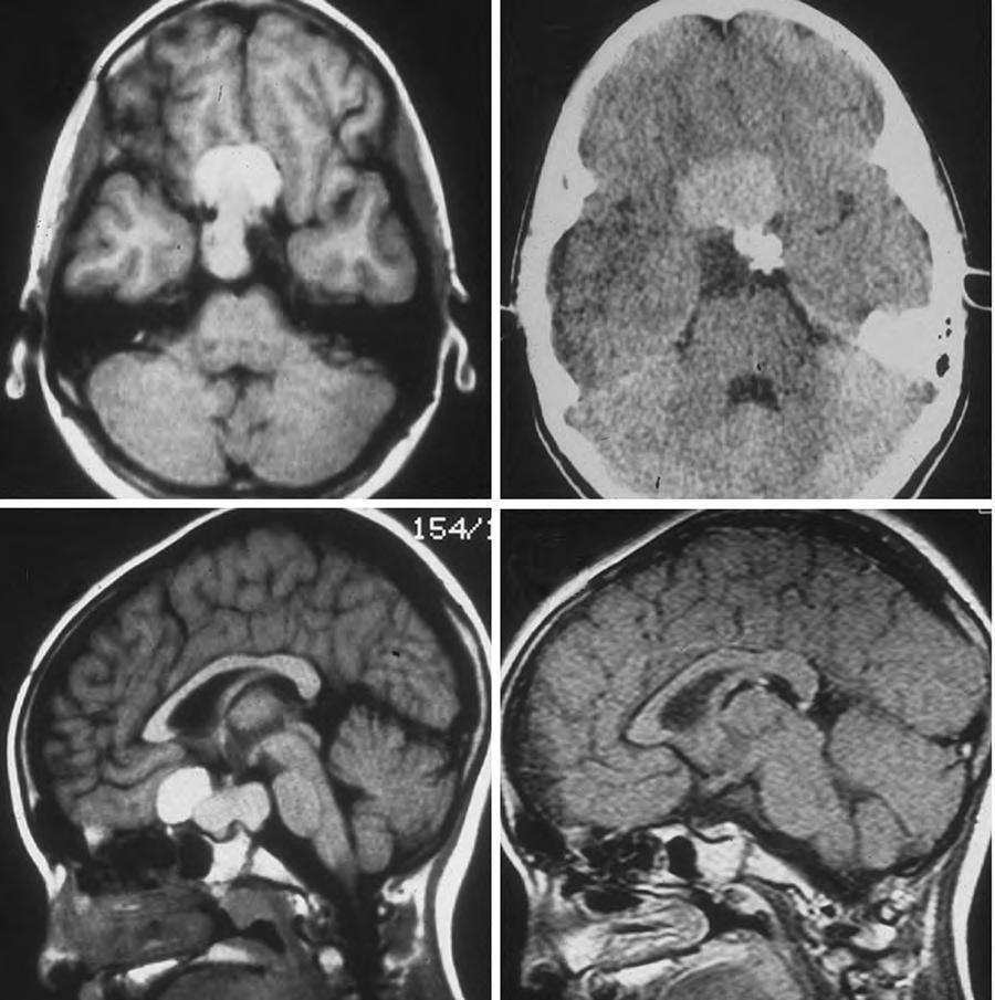 6 Craniopharyngioma 65 A B C D Fig. 6.1 This 9-year-old girl presented with severe, progressive headache.