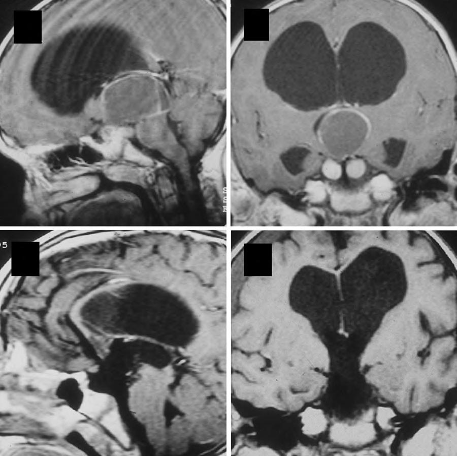 6 Craniopharyngioma 67 A B C Fig. 6.3 (A,B) This 7-year-old boy presented with headache and behavioral outbursts.