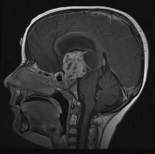 6 Craniopharyngioma 71 Clinical Case 1 A 7-year-old boy presented to his primary care physician offering a 19-week history of nausea, vomiting, and headache.