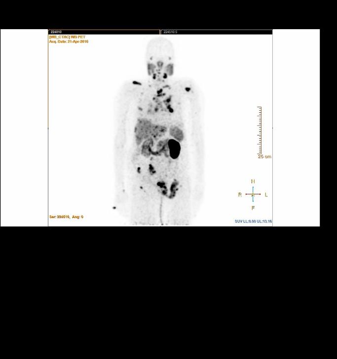 Gallium scan :GA PSMA AVID residual prostate CA + multiple supra & Infradiapghramatic lymph nodal, b/l pulmonary, liver and