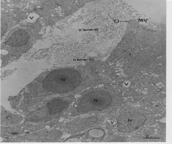TEM micrograph of an enterocyte in the foregut of spotted wolffish fry exposed to Vibrio anguillarum.. Notice the disintegrated microvilli (MV).