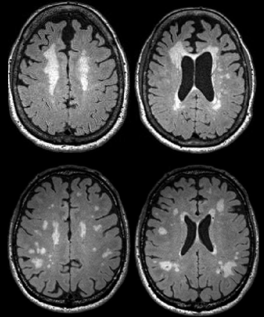 White Matter Injury Subjects over the age of 60 in