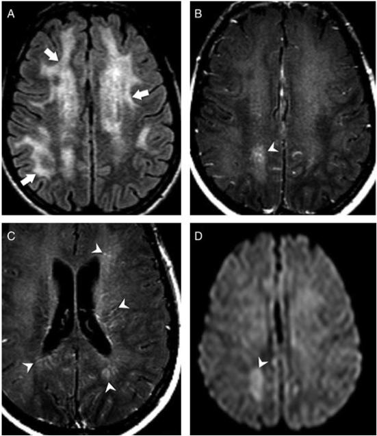 CD8 encephalitis and CNS escape are likely on the same spectrum of HIV-related CNS injury 14 HIV-infected individuals with encephalitis and acute to subacute symptoms of HA, memory impairment,
