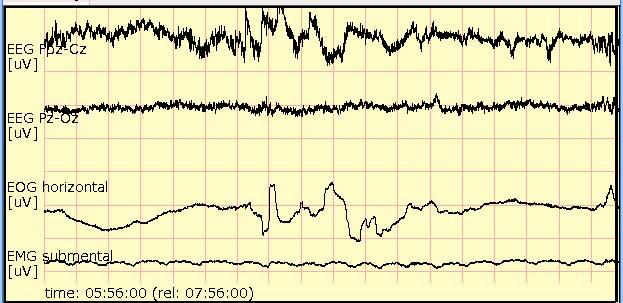 Even in sleep, when EMG is low, EEG and EOG may introduce very large