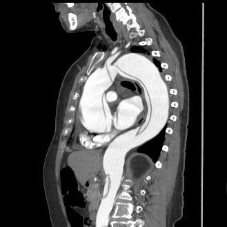 Sagittal projection in MPR of the Stanford type A aortic dissecting aneurysm showing the intimal flap beginning close to the aortic root and