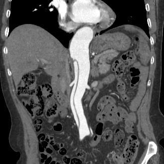 Coronal projection in MPR of the Stanford type A aortic dissecting aneurysm showing the intimal flap extending with a