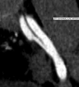 MPR CT image showing aortic dissection involving the left external iliac artery.