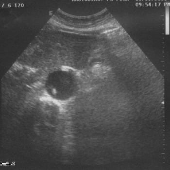 B-mode ultrasound axial scan of the abdominal region (distally than Fig.1 a) showing the diameter of the suprarenal abdominal aortic aneurysm of 37 mm.