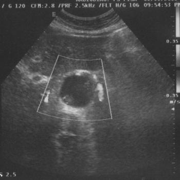 Colour-Doppler ultrasound axial scan showing blood flow