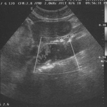 Imaging Technique: Ultrasound; Colour-Doppler ultrasound longitudinal scan showing blood flow between intimal flap
