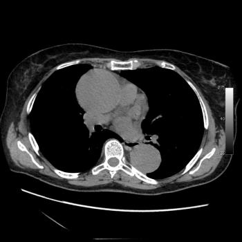 Axial Basal CT showing aneurysm of ascending aorta