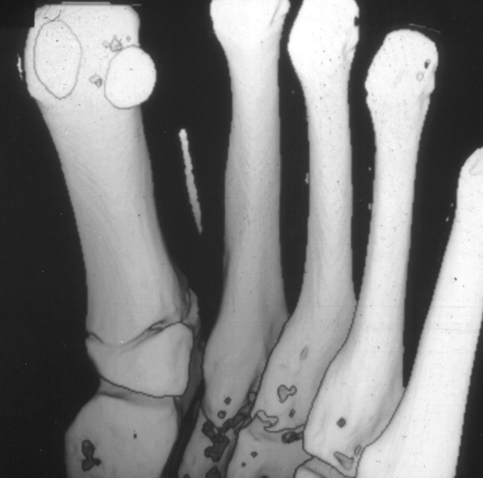 , Three-dimensional surface rendered CT scan of foot shows retained wooden foreign body within soft tissue between first and second metatarsals.