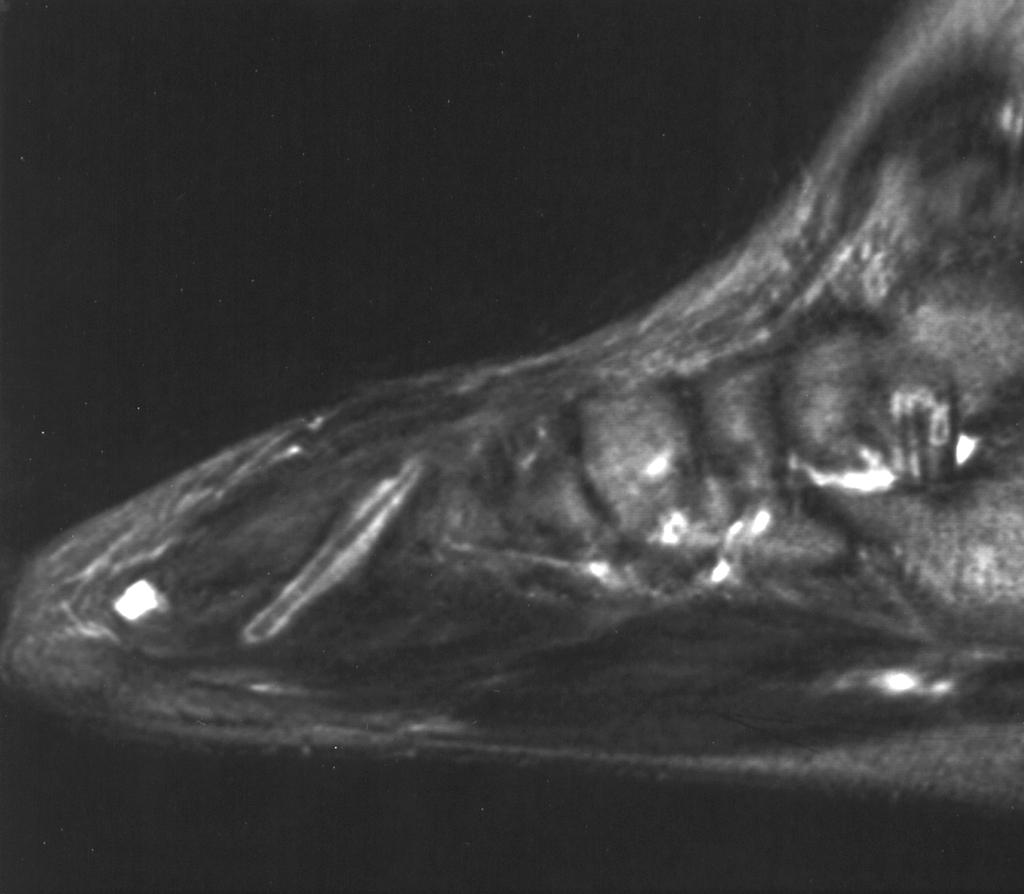 Retained wood, in contrast to metal, does not reveal susceptibility artifact, and linear signal voids may be mistaken for tendons or dense collagenous structures (Fig. 2).