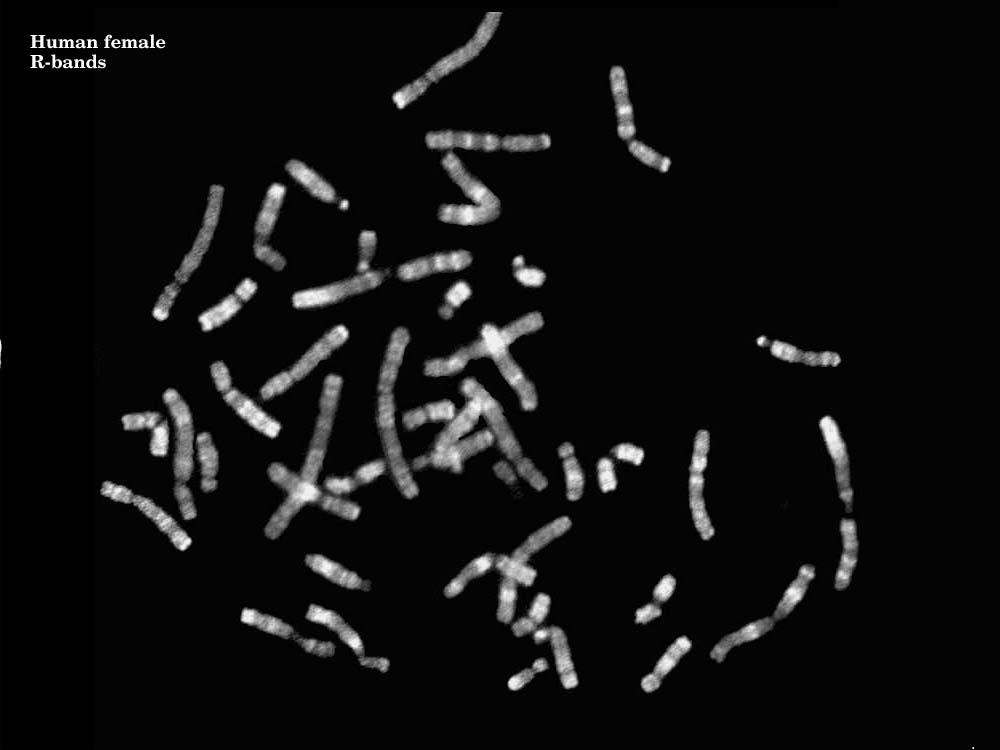 R-banding The chromosomes are heatdenatured then staining with Giemsa R (reverse) banding The chromosomes are heat-denatured before