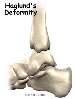 Causes Why do I have this problem? Introduction Sometimes the shape of a bone can cause problems in the foot.