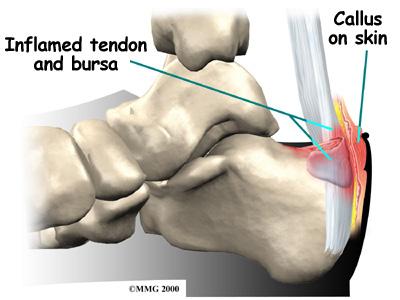 The calcaneus is shaped differently in different people. People who have a prominent bump underneath the attachment of the Achilles tendon are more likely to develop Haglund's deformity.