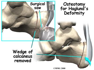 X-rays will usually be required to allow the surgeon to see how the calcaneus is shaped and to make sure there is no other cause for your heel pain. Generally no other tests are required.