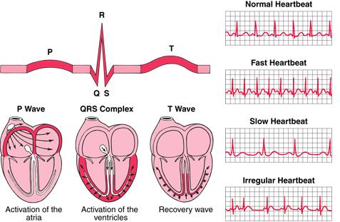 ventricles Can lead to VF and is usually treated with some combination of cardioversion, defibrillation, cardiac ablation, or antiarrhythmic drugs Implantable