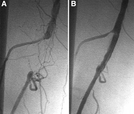 II-56 J ENDOVASC THER Figure 4In the second case example (A), a 6-cmlong total occlusion in the right SFA was treated with the PolarCath catheter.