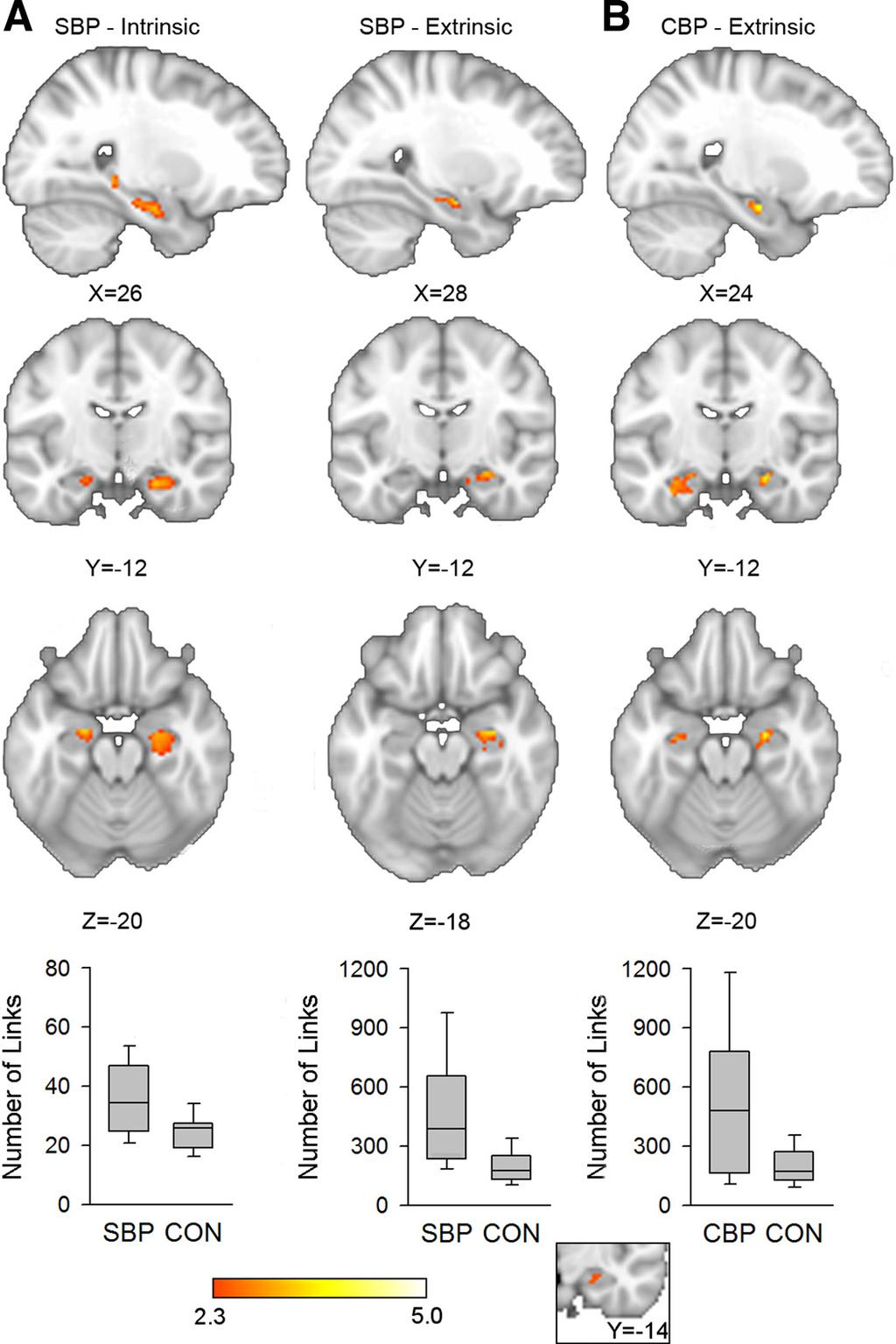 1070 HIPPOCAMPAL FUNCTIONAL CONNECTIVITY AND PAIN Table 2. Locations with greatest connectivity increase relative to control subjects at visit 1 (illustrated in Fig.