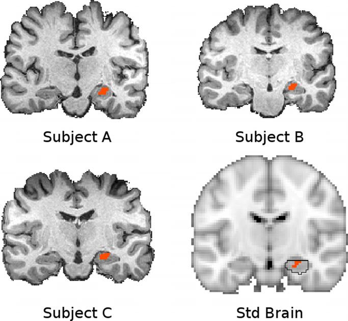 27 Fig. 3. SBP and CBP patients show greater hippocampal connectivity than CON subjects.