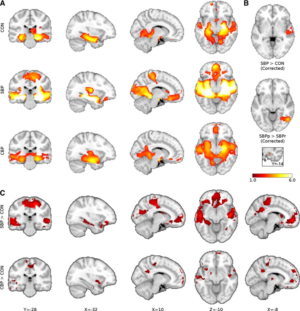 HIPPOCAMPAL FUNCTIONAL CONNECTIVITY AND PAIN 1071 Fig. 5. Hippocampal-cortical connectivity differences between pain patients and CON subjects.